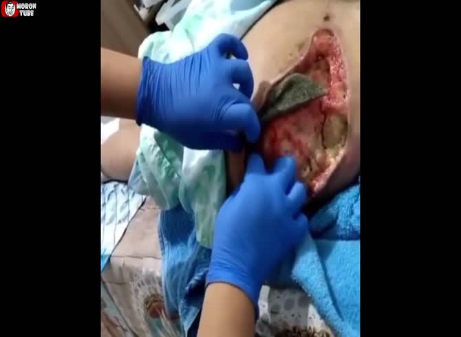 Video :Following buttock plastic surgery, her buttocks became necrotic (publicly advertised)